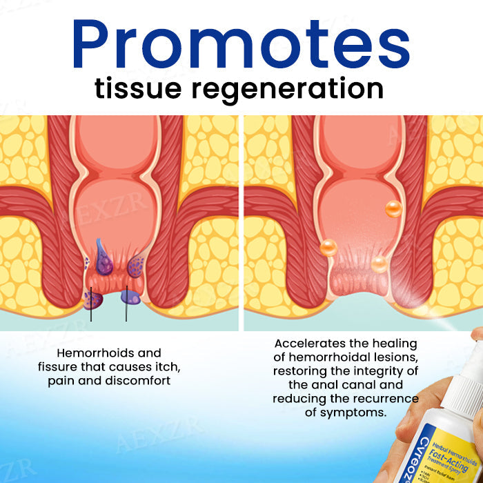 🌟 Official Store | Cvreoz® Herbal Hemorrhoids Fast-Acting Treatment Spray – Your Quick Relief Solution!