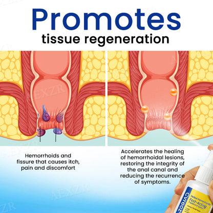 🌟 Official Store | Cvreoz® Herbal Hemorrhoids Fast-Acting Treatment Spray – Your Quick Relief Solution!