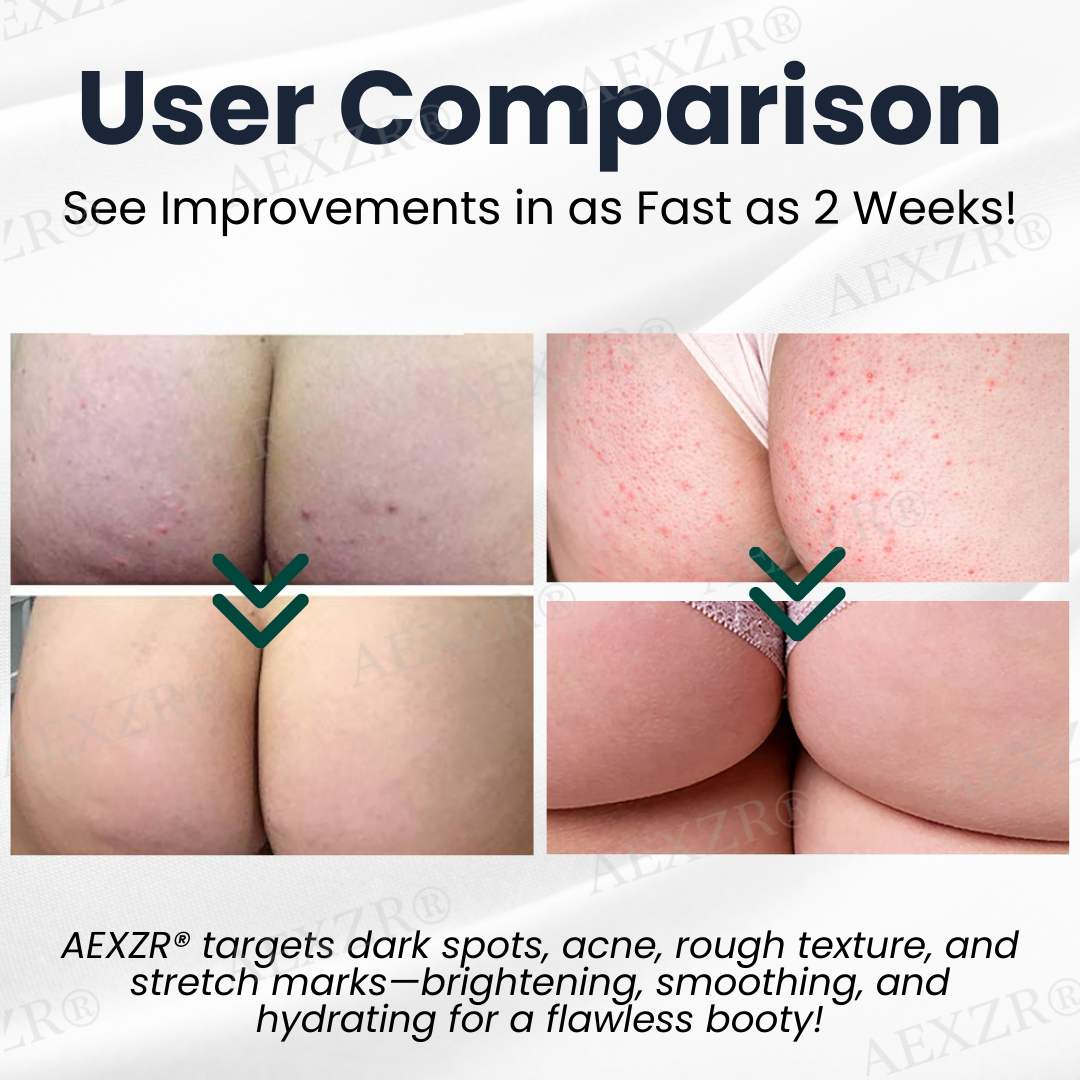 🌟 Official Store | AEXZR® Butt Skin Treatment Cream💕 Say Goodbye to Bumps and Hello to Smooth, Radiant Skin!