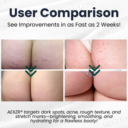 🌟 Official Store | AEXZR® Butt Skin Treatment Cream💕 Say Goodbye to Bumps and Hello to Smooth, Radiant Skin!