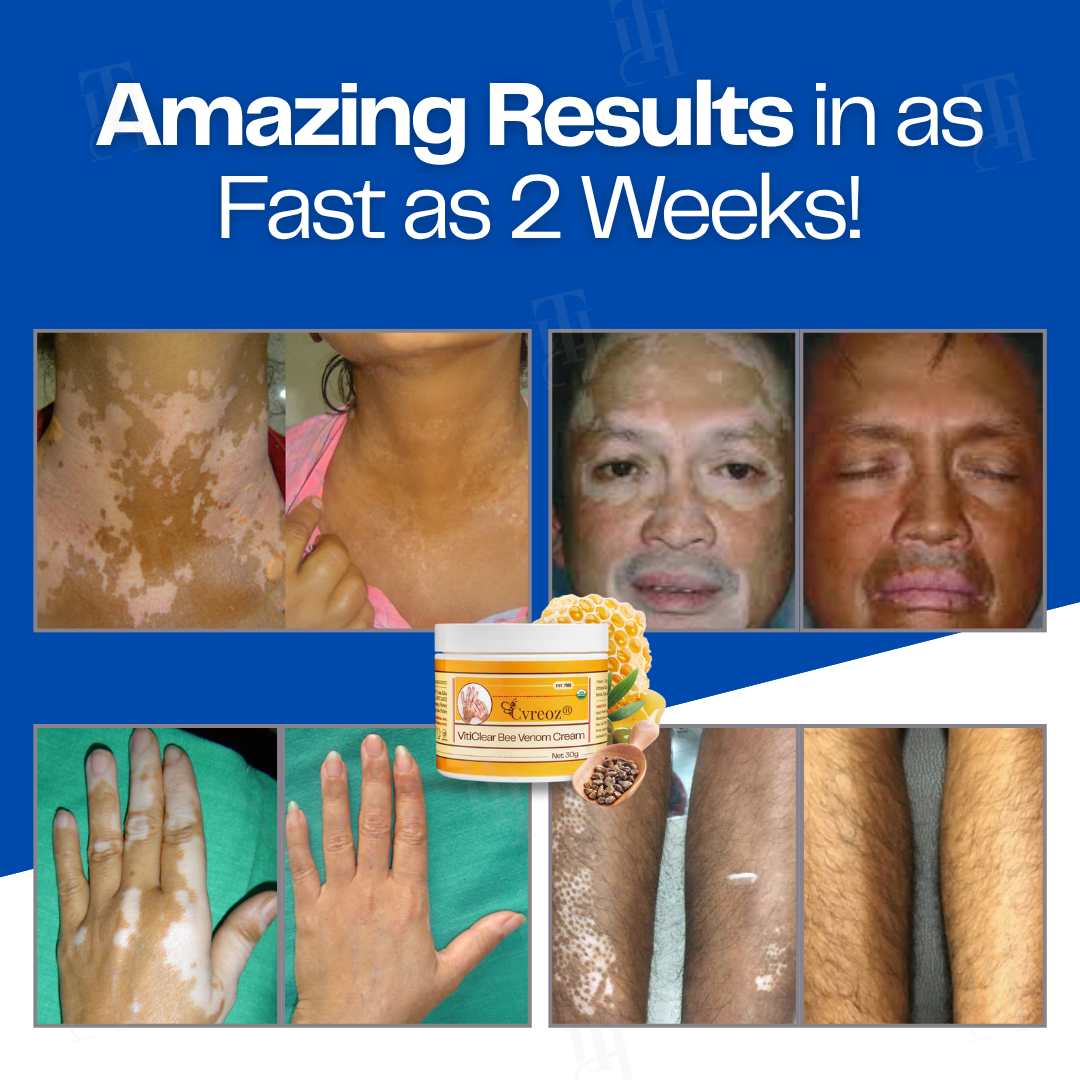 17 Pieces LEFT!!.. Cvreoz® VitiClear Bee Venom Cream