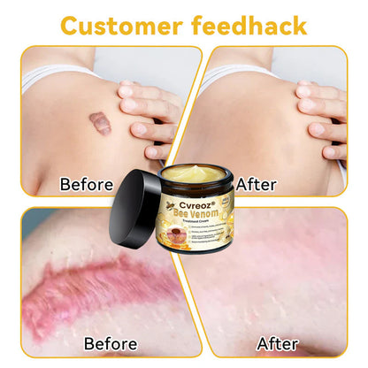🌟 Last 14Pcs Left | Cvreoz® Bee Venom Skin Treatment Cream