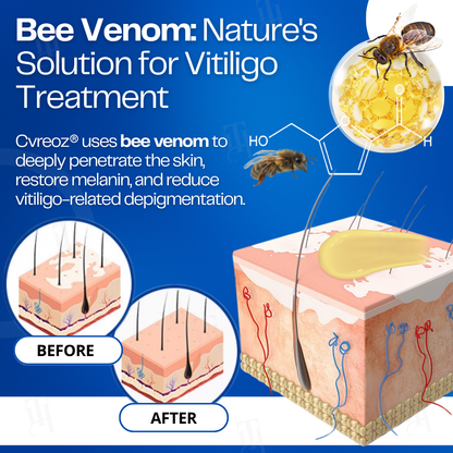 17 Pieces LEFT!!.. Cvreoz® VitiClear Bee Venom Cream