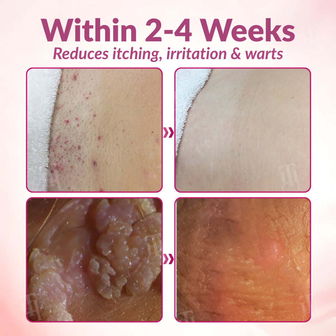 🌸 Official Store | Piguiay® Femina HPV Relief Gel – Your Gentle Solution to HPV Symptoms!💕